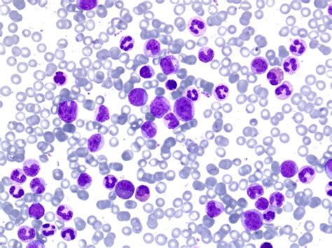 Leucemia Mieloide Crónica Bcr Abl1