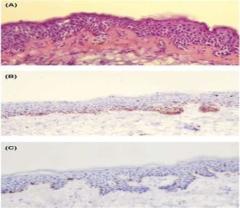 Excision Margins For Melanoma In Situ On The Head And Neck