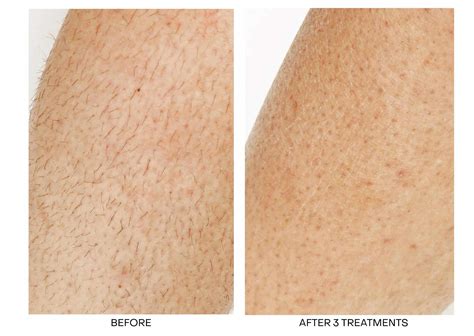 Laser Hair Removal Richmond Hill Best Laser Hair Removal Near Me