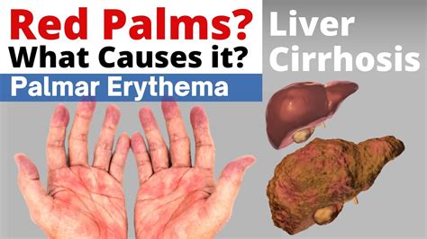 Understanding Palmar Erythema In The Context Of Liver Cirrhosis