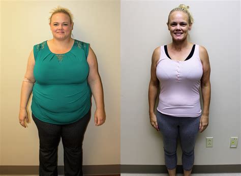 Gastric Sleeve Before And After Photos St Louis Bariatrics My Xxx Hot