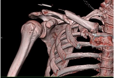 Non Union Of Clavicular Fracture Musculoskeletal Case Studies