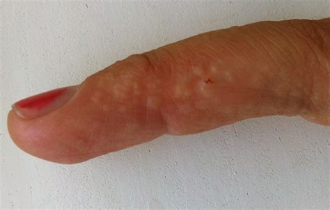 Dyshidrosis Pictures Causes Prevention And Cure Healthdiseasesorg