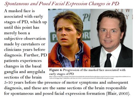 The centers for disease control and prevention (cdc) rated complications from pd as the 14th cause of death in the united. SDK on the Spot: FacePrint Emotion Recognition Program Detects Early Parkinson's Disease Symptoms