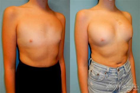 Breast Augmentation Before And After Pictures Case 183 Las Vegas NV