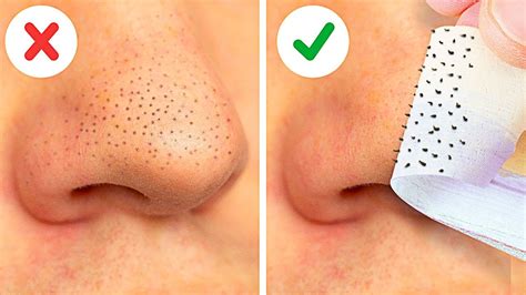 22 Easy Ways To Remove Blackheads Fast Face Masks Natural Beauty