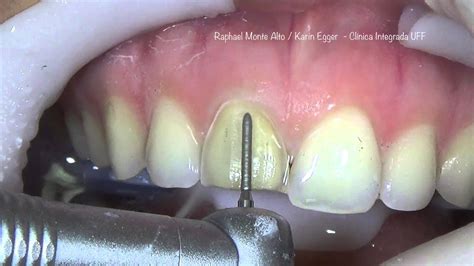 preparacion  provisorio  una carilla dental paso