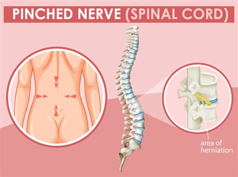 Can A Chiropractor Help A Pinched Nerve An Tâm