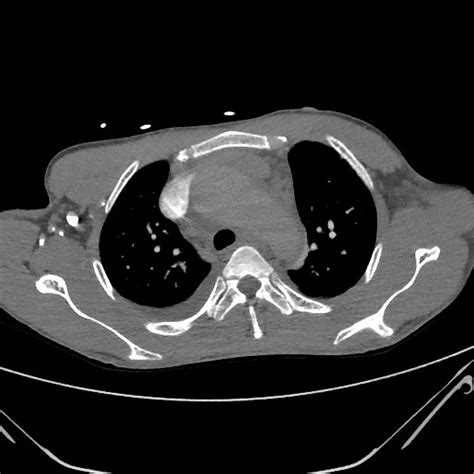 Aortic Dissection On Ctpa Radiology Case