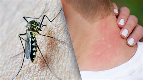 5 Consejos Para Evitar Las Picaduras De Mosquitos