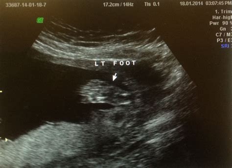 Baby Ultrasound Pictures 2 Months Baby Viewer