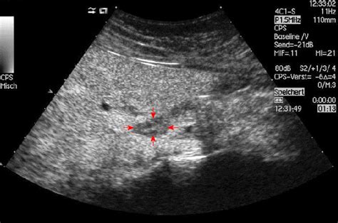 Enlarged Perihepatic Lymph Nodes Dorsal In The Hepatoduodenal Ligament