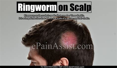Ringworm in cats is a fungal pores and skin infection that. Ringworm on Scalp & Fastest Ways to Get Rid of it ...