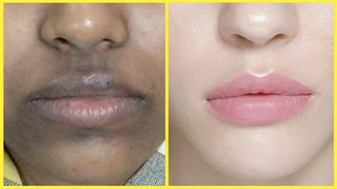 How To Remove Pigmentation Around Mouth How To Get Rid Of