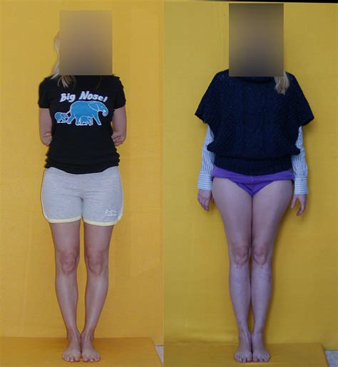 Height Increase Operation Limb Lengthening