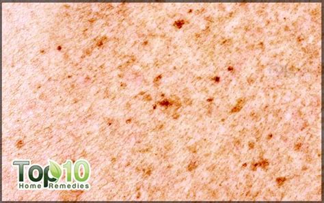 How To Get Rid Of Brown Spots On Skin Top 10 Home Remedies