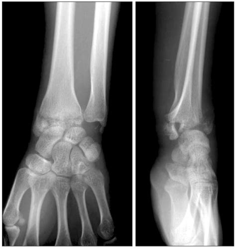 Anteroposterior And Lateral Radiographs Show A Severe Intra Articular