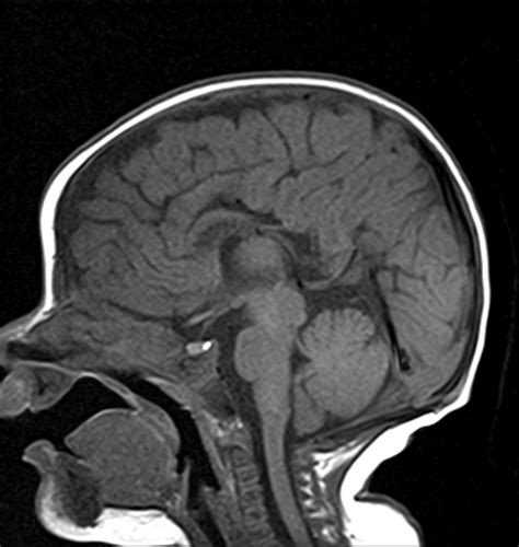 Dysgenesis Of Corpus Callosum With Atretic Occipital Cephalocele