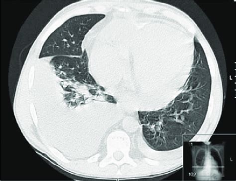 Thoracic Ct Scan Showing Bilateral Pleural Effusions More Pronounced On