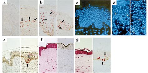 Demonstration Of Apoptotic Kcs In Ad Atopy Patch Tests Acd And In