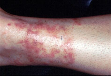 Tinea Infections As Related To Conventional Medicine Pictures