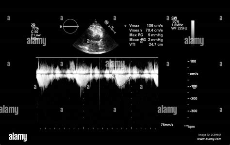 Ultrasonido Ecocardiografia Imágenes De Stock En Blanco Y Negro