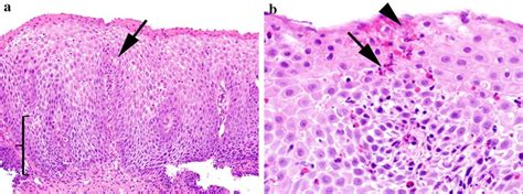 Histologic Findings Of Eoe A This Low To Medium Power Photomicrograph
