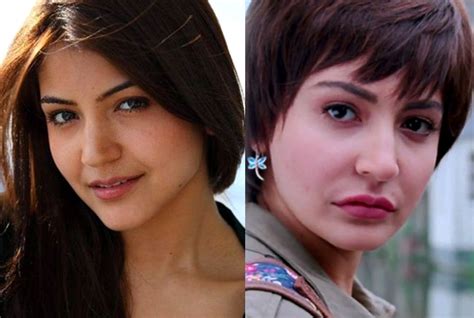 Anushka Sharma Plastic Surgery Before And After