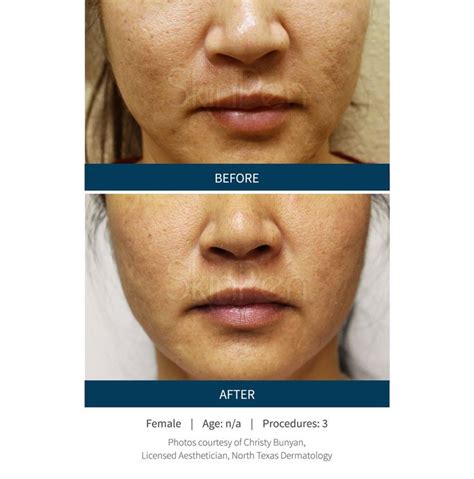 Microneedling Before And After Aging Skin Care Diy Anti Aging Skin
