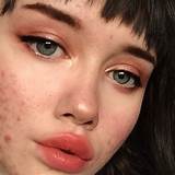 What Makeup To Use For Acne Photos