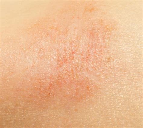 How Do I Tell The Difference Between Eczema And Dry Skin