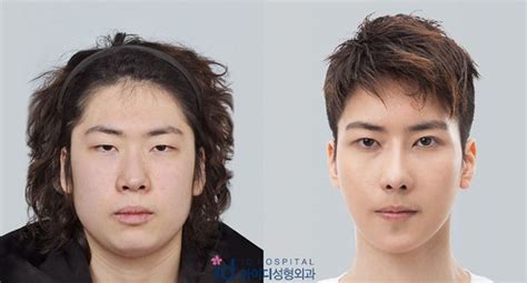 Korean Man Face Plastic Surgery Chin Lips And Nose Before And