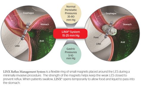 Acid Reflux Or Gerd And The Linx Procedure Lincoln Surgical Associates