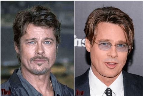 Celebrity Male Plastic Surgery Before And After Photos