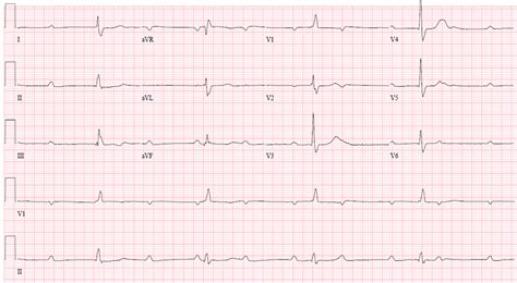 However, the actual heart rate is slow reflecting a ventricular escape rhythm which is. Flashcards - CCL - How do you calculate rate from EKG ...