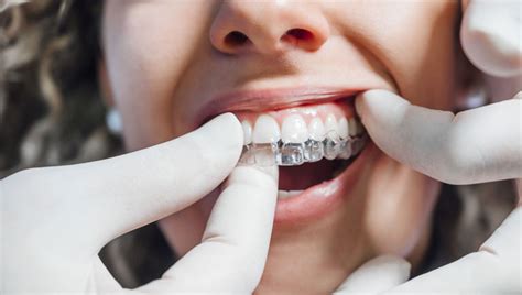 Effaf Plak Tedavisi Ne Kadar S Rer Dentagora A Z Ve Di Sa L