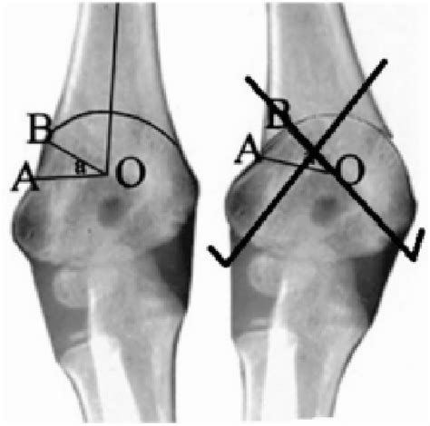 Pdf Outcome Of Dome Osteotomy For Cubitus Varus Correction In