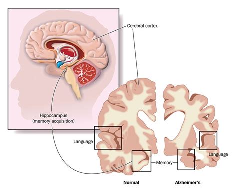 The disease affects different parts of the brain but has its worst effects on the areas of the. Alzheimer's Disease - Symptoms, Causes & Treatment of ...