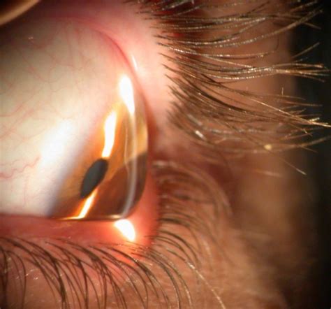 Keratoconus Ocular