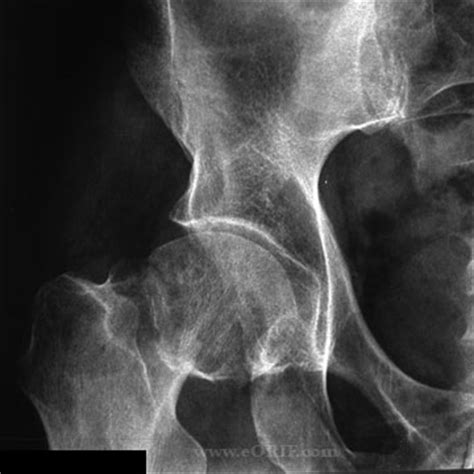 Femoral Neck Fracture S72.019A 820.00 | eORIF