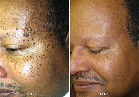 How To Remove Dark Spots From Dark Skin