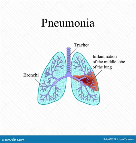 Pneumonia The Anatomical Structure Of The Human Lung Stock