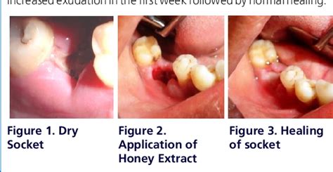 Figure 1 From Comparative Evaluation Of Honey Extract And Zno Eugenol