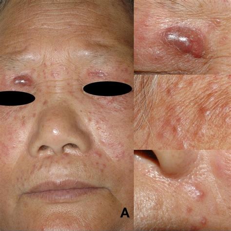 A Variably Sized Erythematous Dome Shaped Papules On The Face With