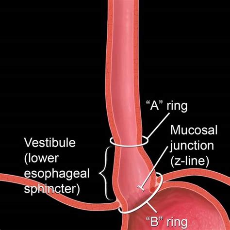 Lower Esophageal Ring Pictures