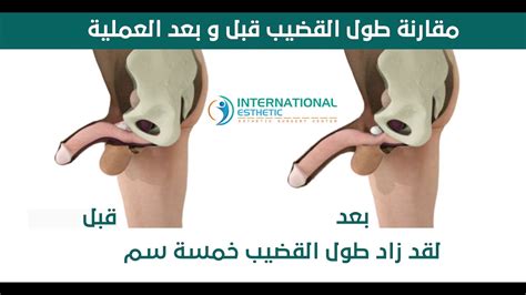 أثبتت دراسات حديثة دور اللّبان واللبان الذكر في وقف نشاط بعض الخلايا السرطانية وخاصة سرطان المبيض وذلك لاحتوائه على نسبة عالية يحتوي اللّبان الذكر على كميّات مرتفعة من الكورتيزون الطبيعي ويتميز هذا العنصر بعدم تسبّبه بأيّ اثار جانبيّة للجسم إلّا في حال. ‫فيديو عملية تكبير العضو الذكري | القضيب 3D‬‎ - YouTube