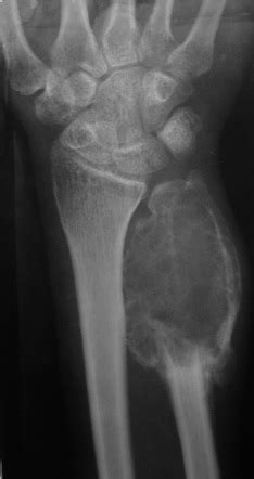 Giant cell tumor of bone | Radiology Reference Article | Radiopaedia.org