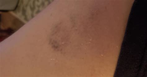 Should I Be Concerned About This Bruise On My Thigh