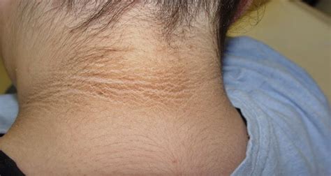 Acanthosis Nigricans What You Need To Know About This Condition