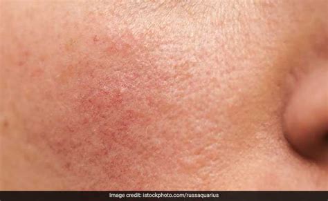 7 Natural Remedies For Rosacea Or Adult Acne We Bet You Didnt Know These